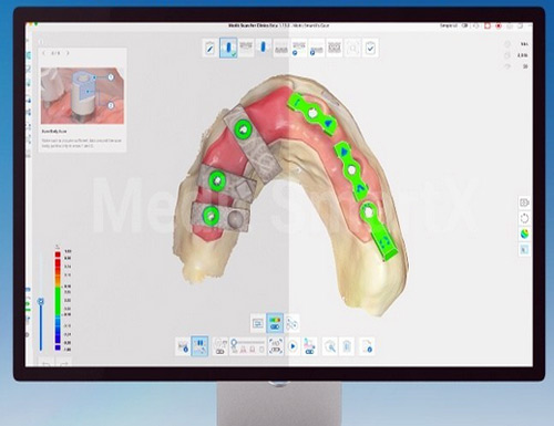 Medit introduces SmartX, a new All-on-X solution for digital dentistry