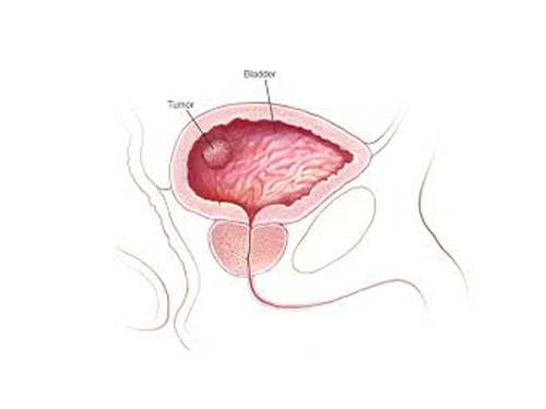 BCG-unresponsive non-muscle invasive bladder cancer