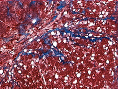 Trailblazing 3D human liver models yield accurate MASH phenotype