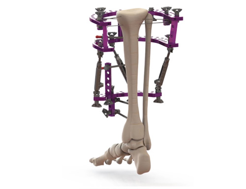 Strategic Expansion Expands Fusion Orthopedics' Foot & Ankle Reach